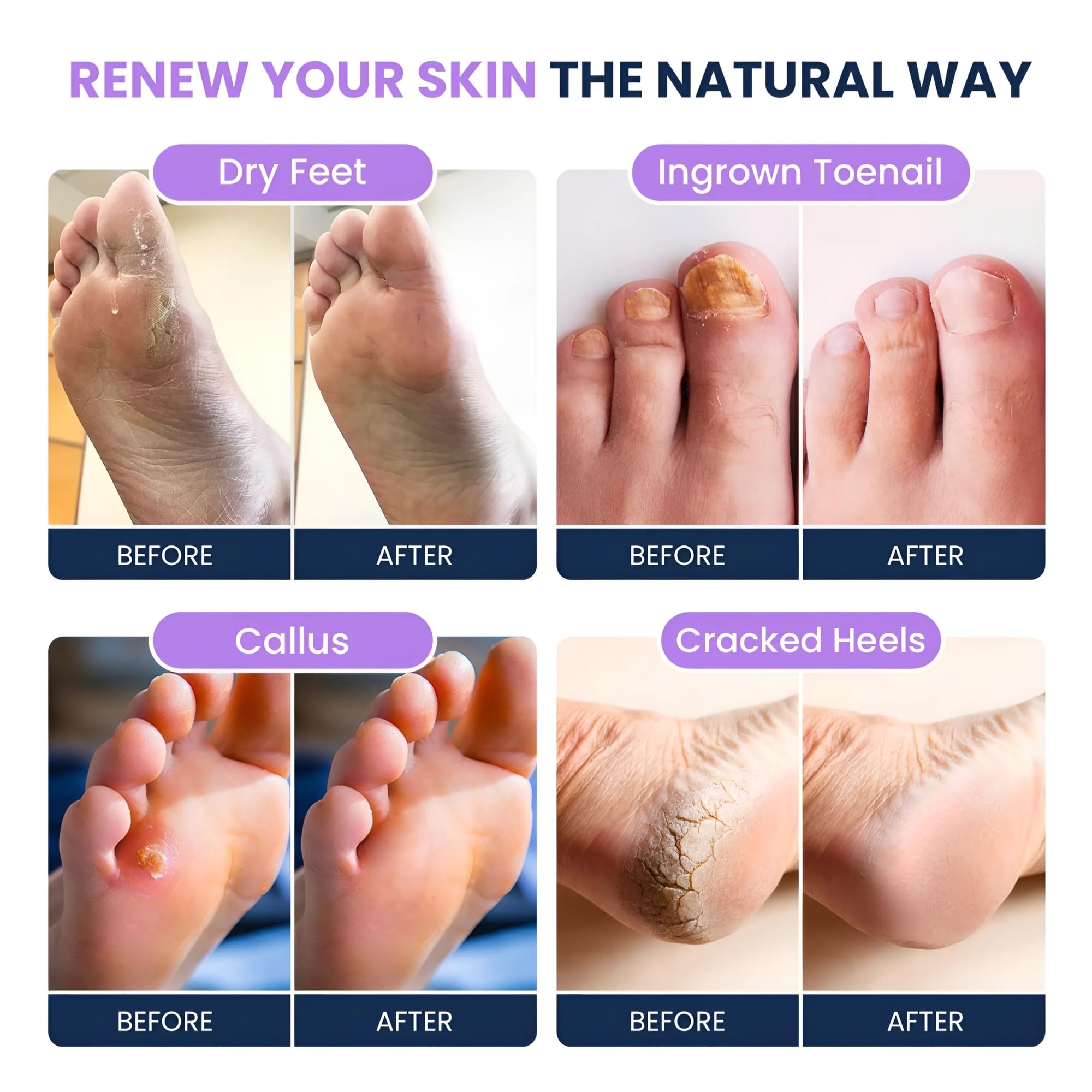 FOOT CURE raspador-pies, exfoliación suave para pies lisos.