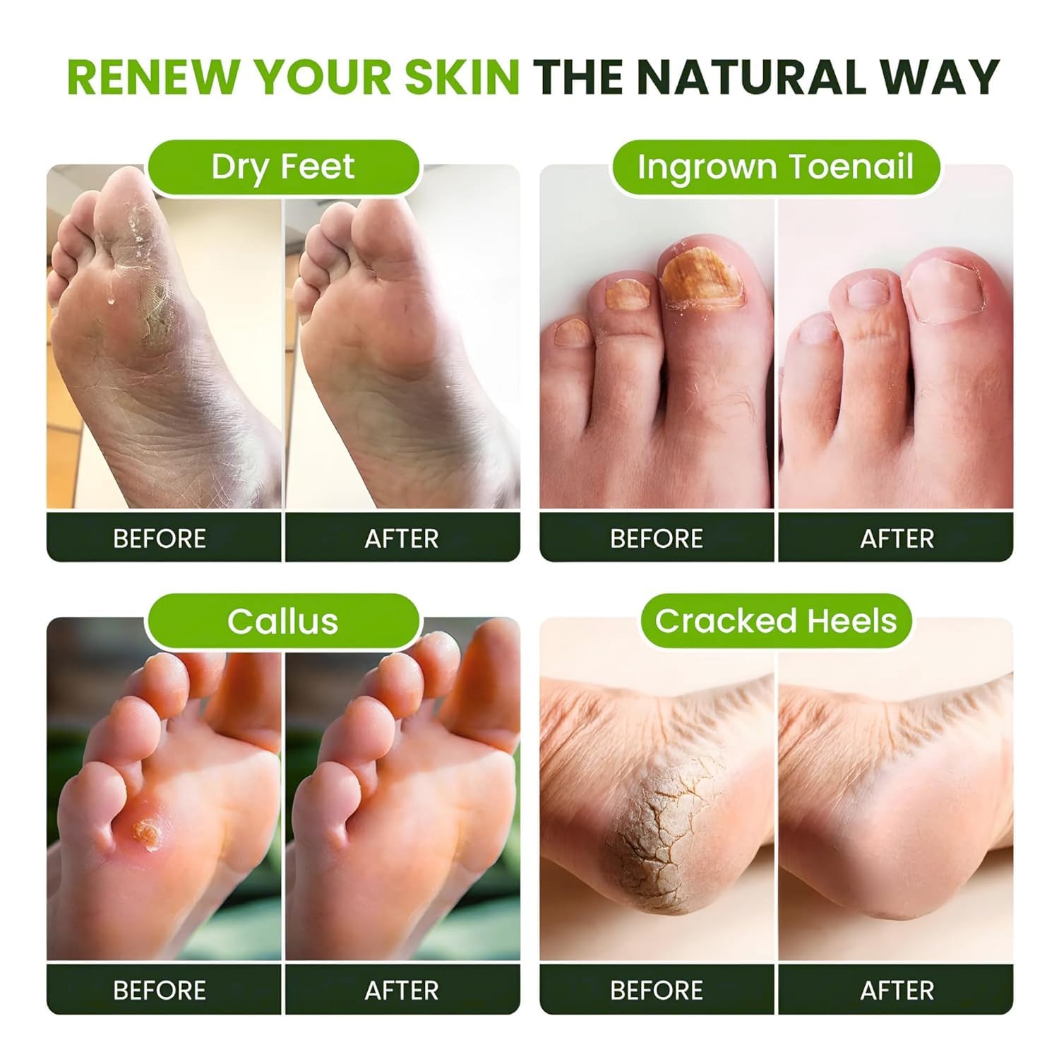 Foot Cure soft feet after use with silky-smooth look