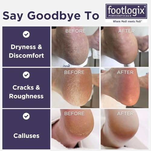 Footlogix double-sided foot file with rubberized handle for efficient callus removal