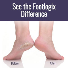 Footlogix Dry Cracked Heel closeup highlights care for tough skin.