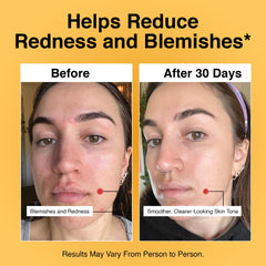 Foundation Skincare azelaic acid 14% label detail signals dermatologist-backed formula for sensitive skin