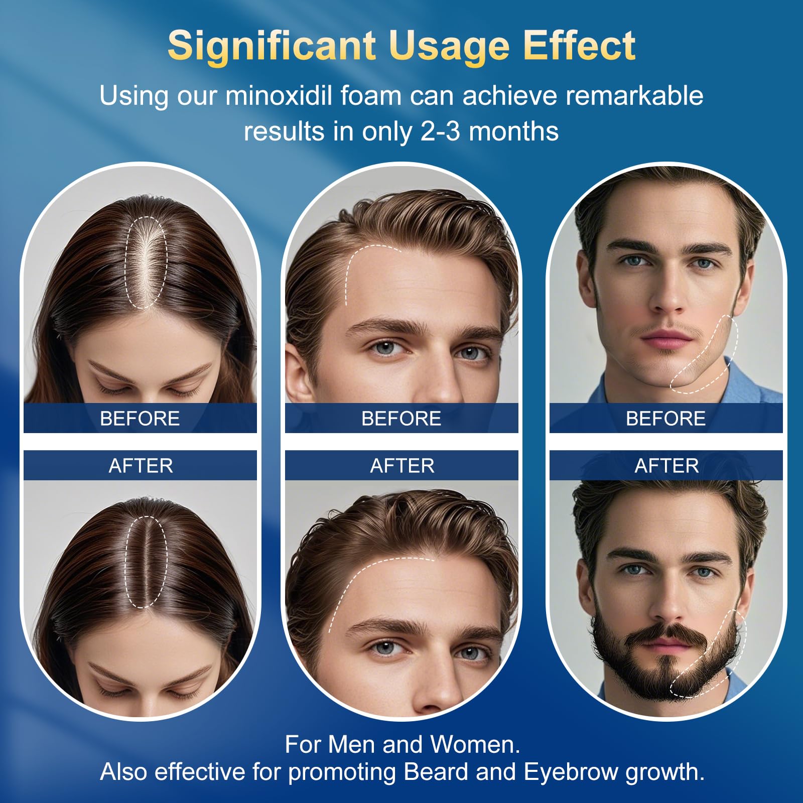 Frnoip Minoxidil Foam on scalp demonstrates thinning hair support and coverage