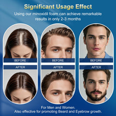 Frnoip Minoxidil Foam on scalp demonstrates thinning hair support and coverage