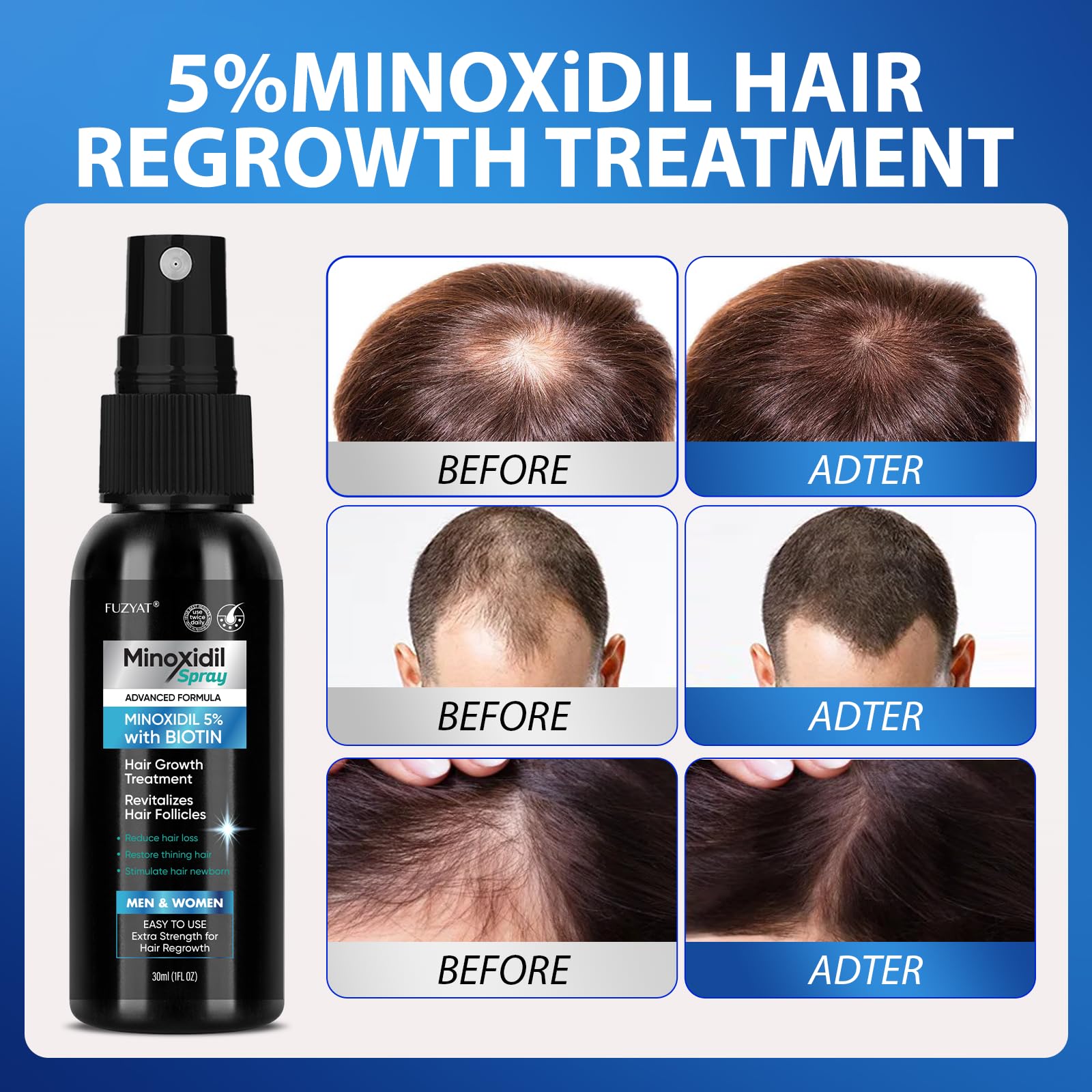FUZYAT Minoxidil para crecimiento de cabello, con biotina e niacinamida.