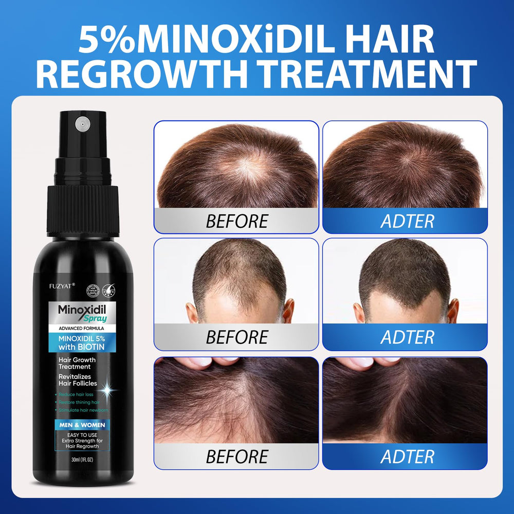 FUZYAT Minoxidil para crecimiento de cabello, con biotina e niacinamida.