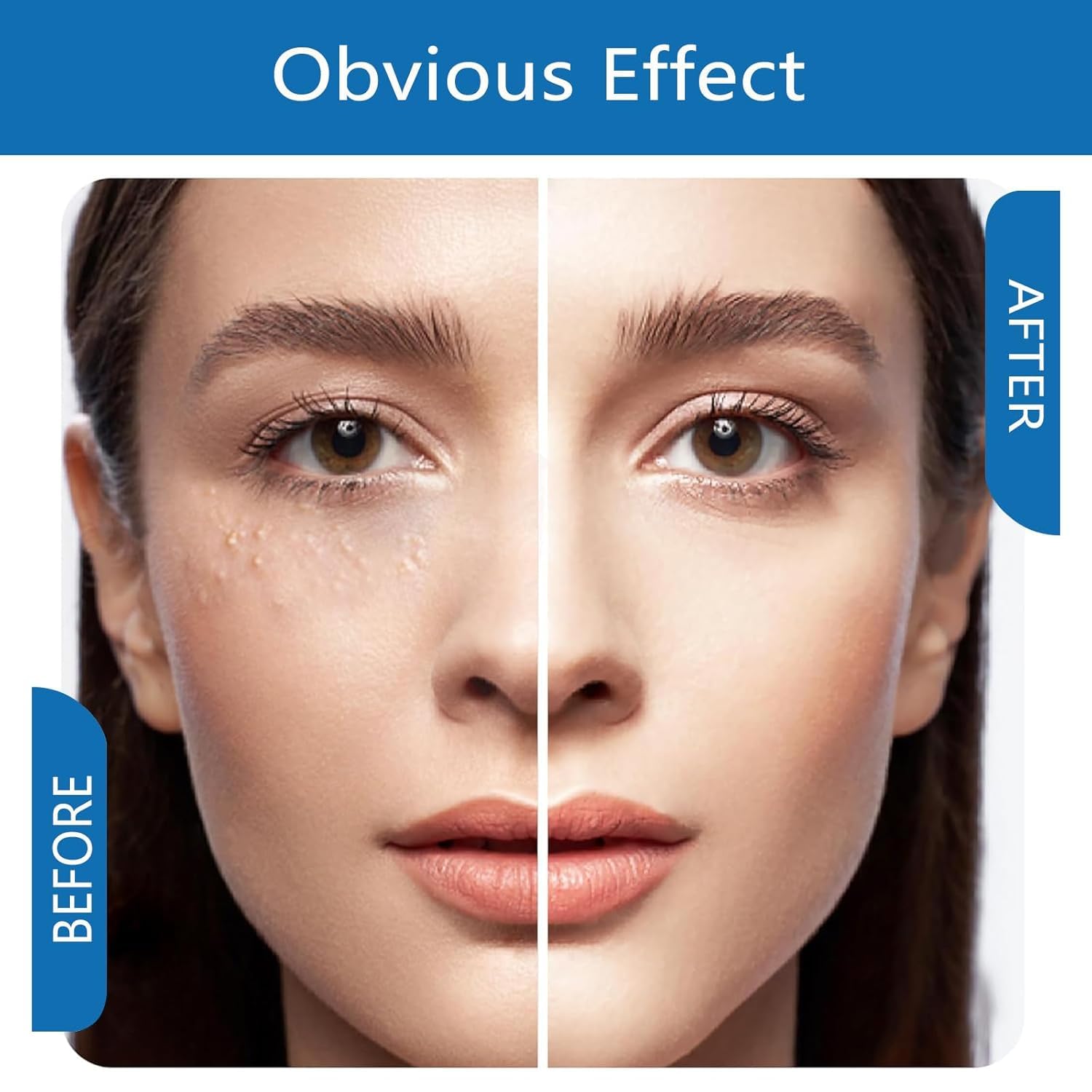 Fvtcnbu Milia Remover Serum refines nose contour and pore appearance.