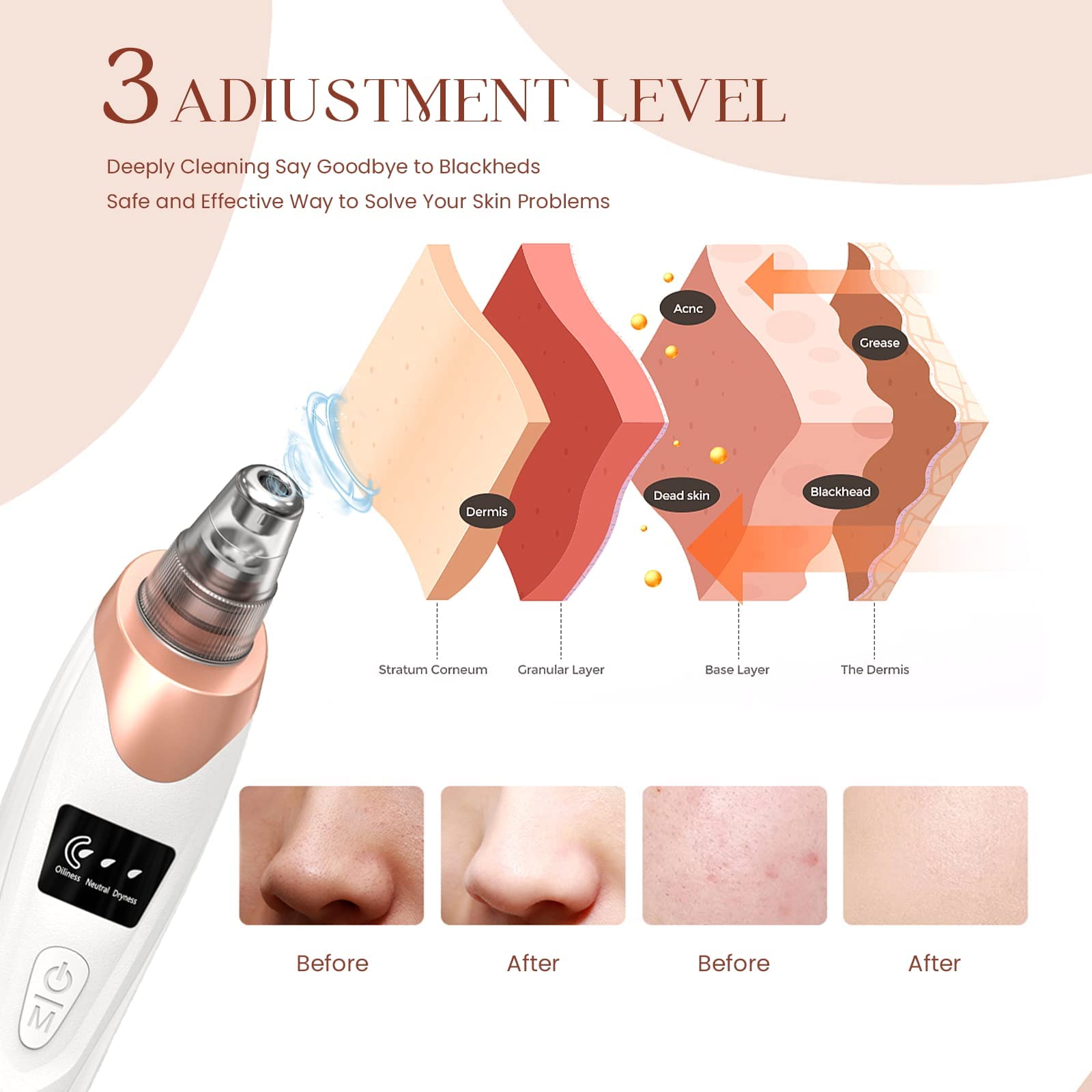 Gackoko 2025 Blackhead Remover probe set demonstrates targeted cleaning for blackheads and dead skin