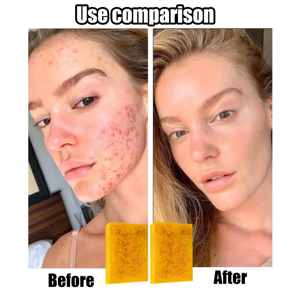 Generic Lemon Turmeric Kojic Soap with foaming net creates dense lather for thorough cleansing
