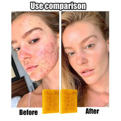 Generic Lemon Turmeric Kojic Soap with foaming net creates dense lather for thorough cleansing