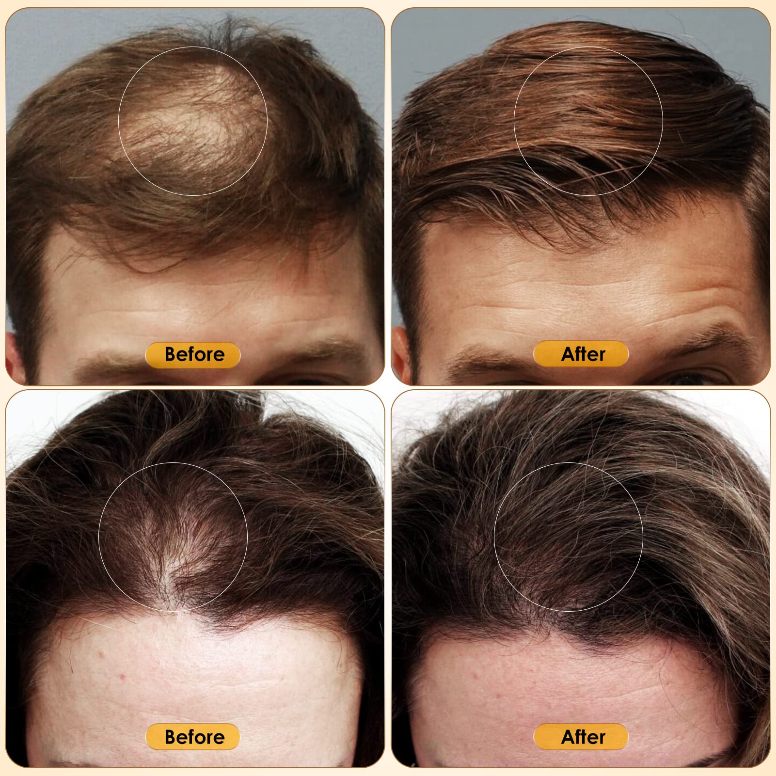 Glemme 5% Minoxidil beard growth support for facial hair.