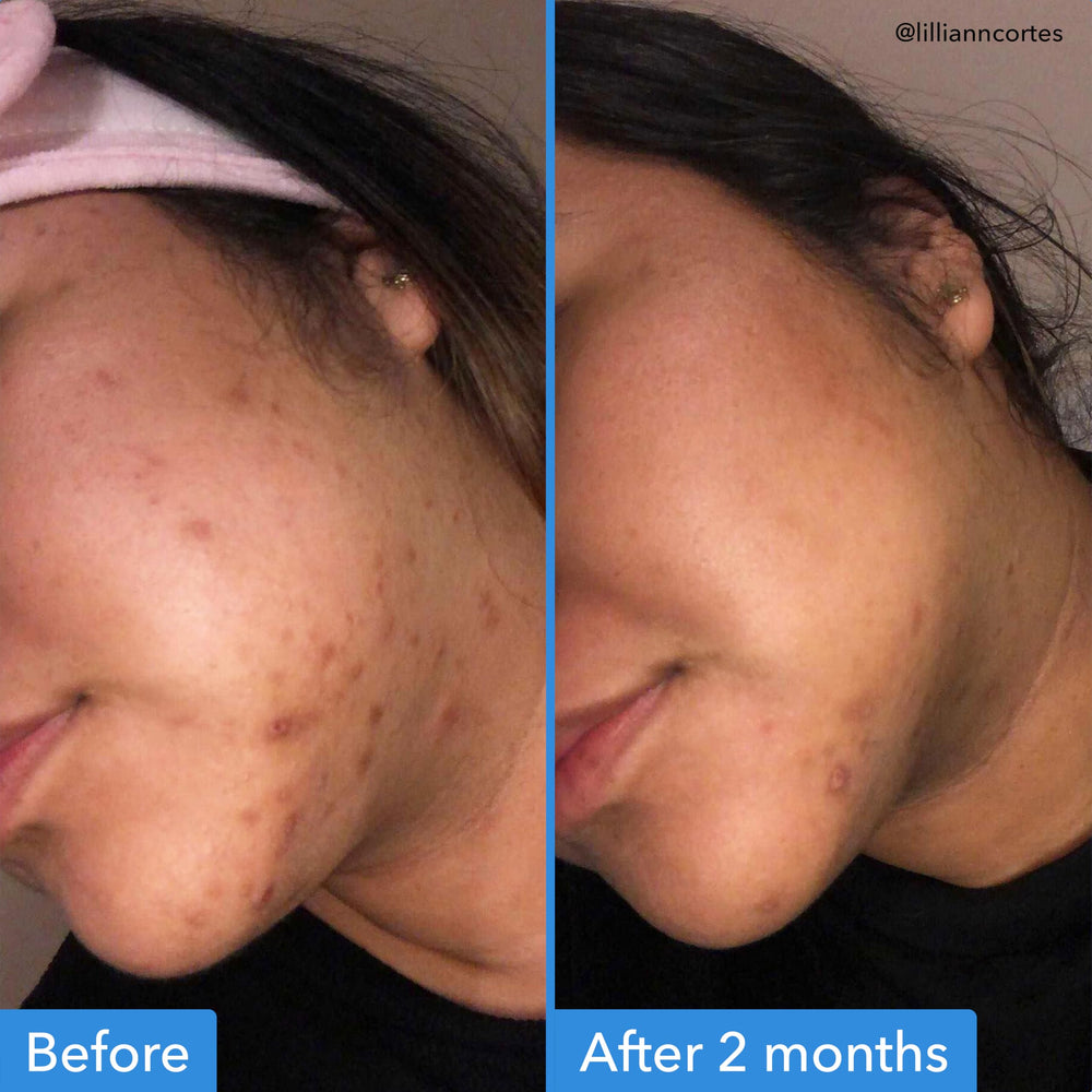 Good Molecules Discoloration Correcting Serum front label lists tranexamic acid and niacinamide.