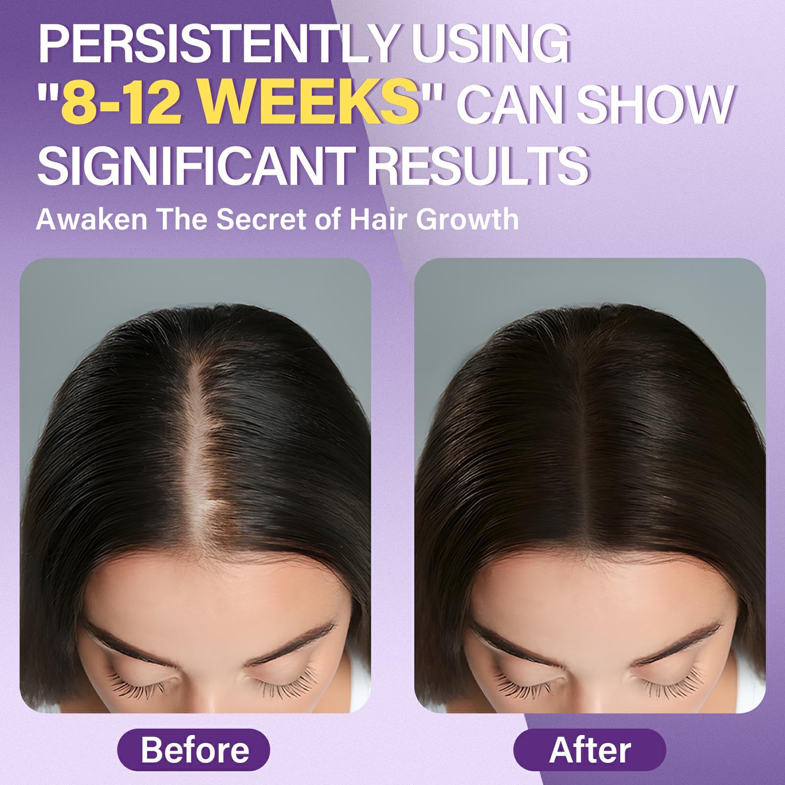 Greoay minoxidil foam on crown area for fuller looking hair
