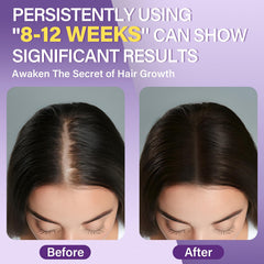 Greoay minoxidil foam on crown area for fuller looking hair
