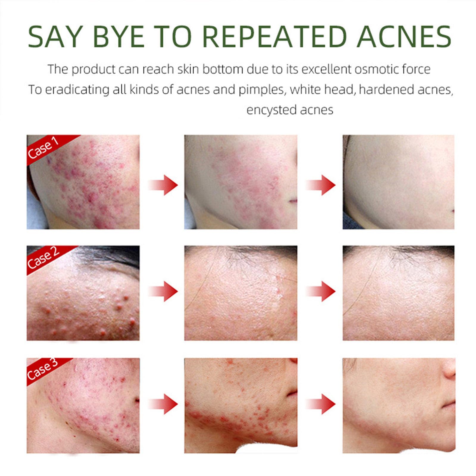 Grospe Acne Removing Cream results suggest fewer pimples and smoother skin