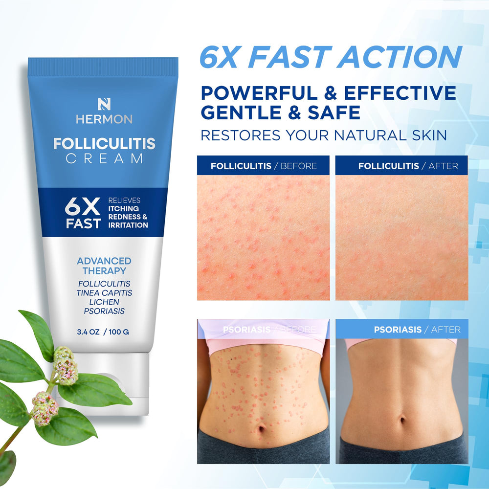 Hermon Folliculitis Cream label close-up highlighting a clean, soothing formula for skin.