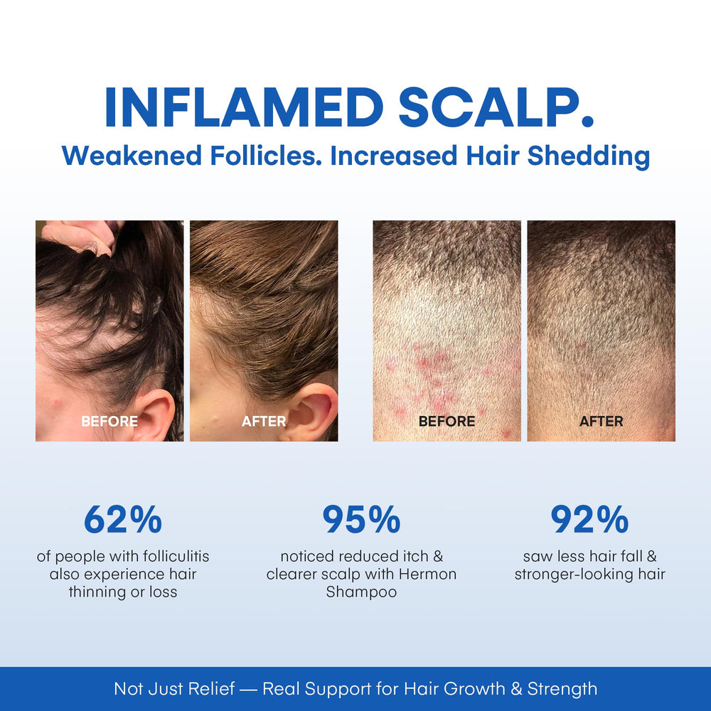 Hermon Folliculitis Shampoo hair root view emphasizing fuller-looking roots.