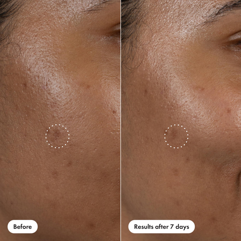 Potential 7-day improvement in post-blemish appearance during real-life use.