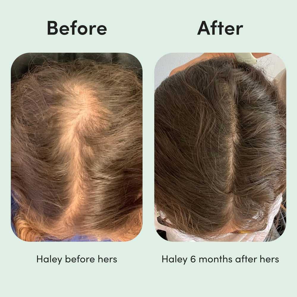 hers Hair Regrowth 2-percent foam packaging with clear branding