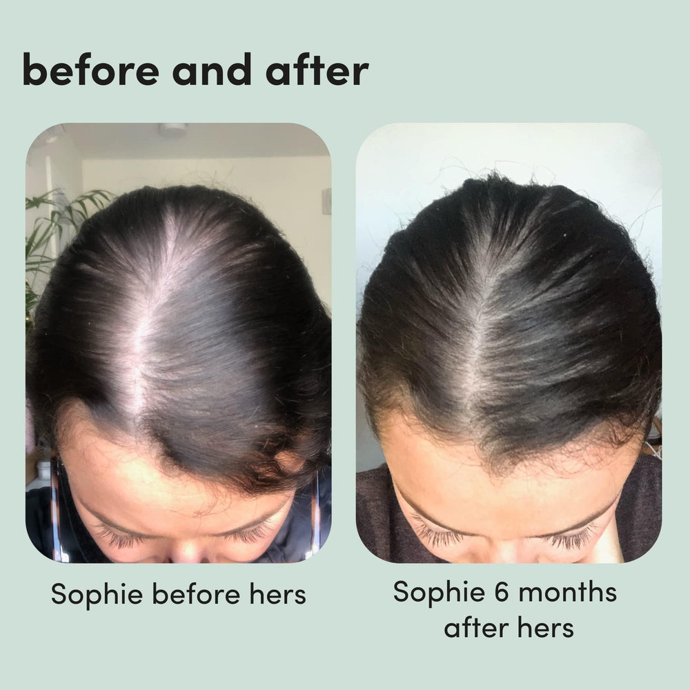 Hims & Hers hair regrowth foam 2-pack box signaling value and convenience.