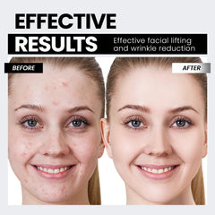 Hunvva EP-300 used on neck contour to support lifted jawline.