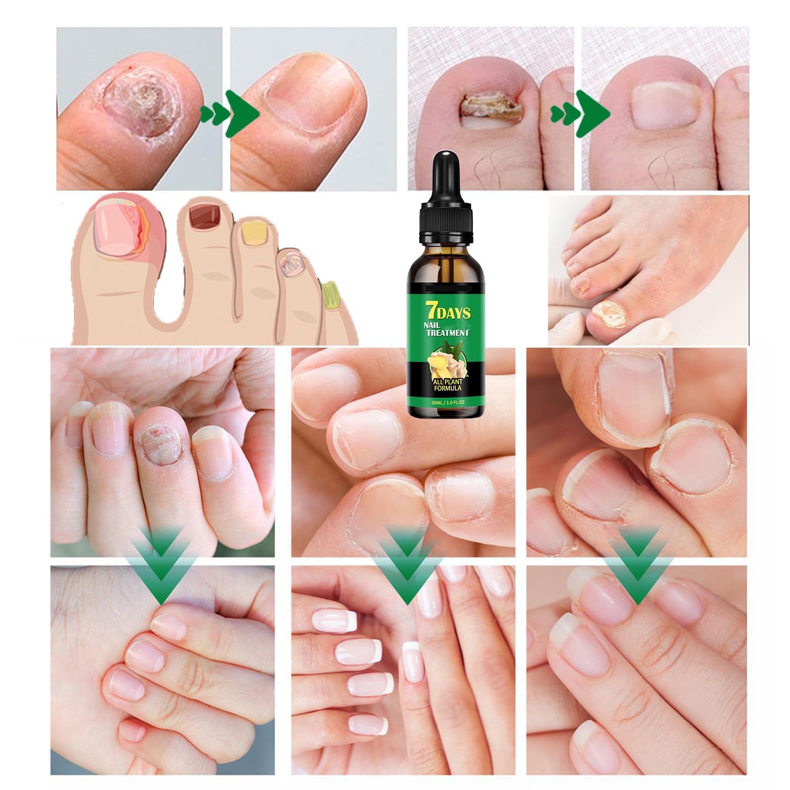 IMOLL ginger nail growth serum dropper applying to nails.