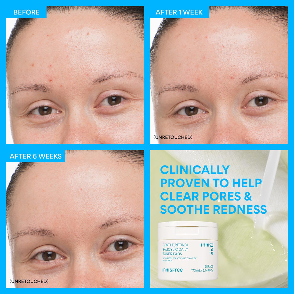 innisfree Daily Gentle Retinol Salicylic Toner Pads with green tea ceramide soothe redness.