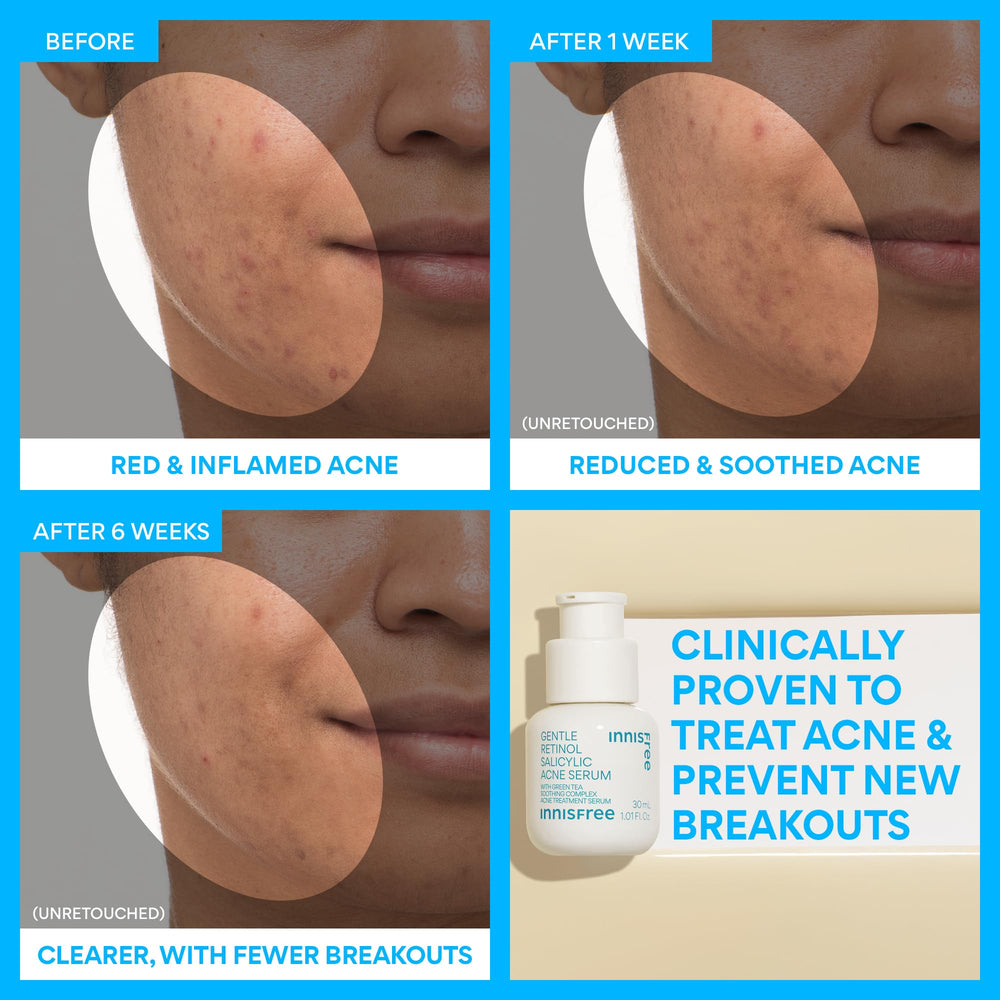 Innisfree serum dispenser with dropper enabling controlled dosing for acne care.