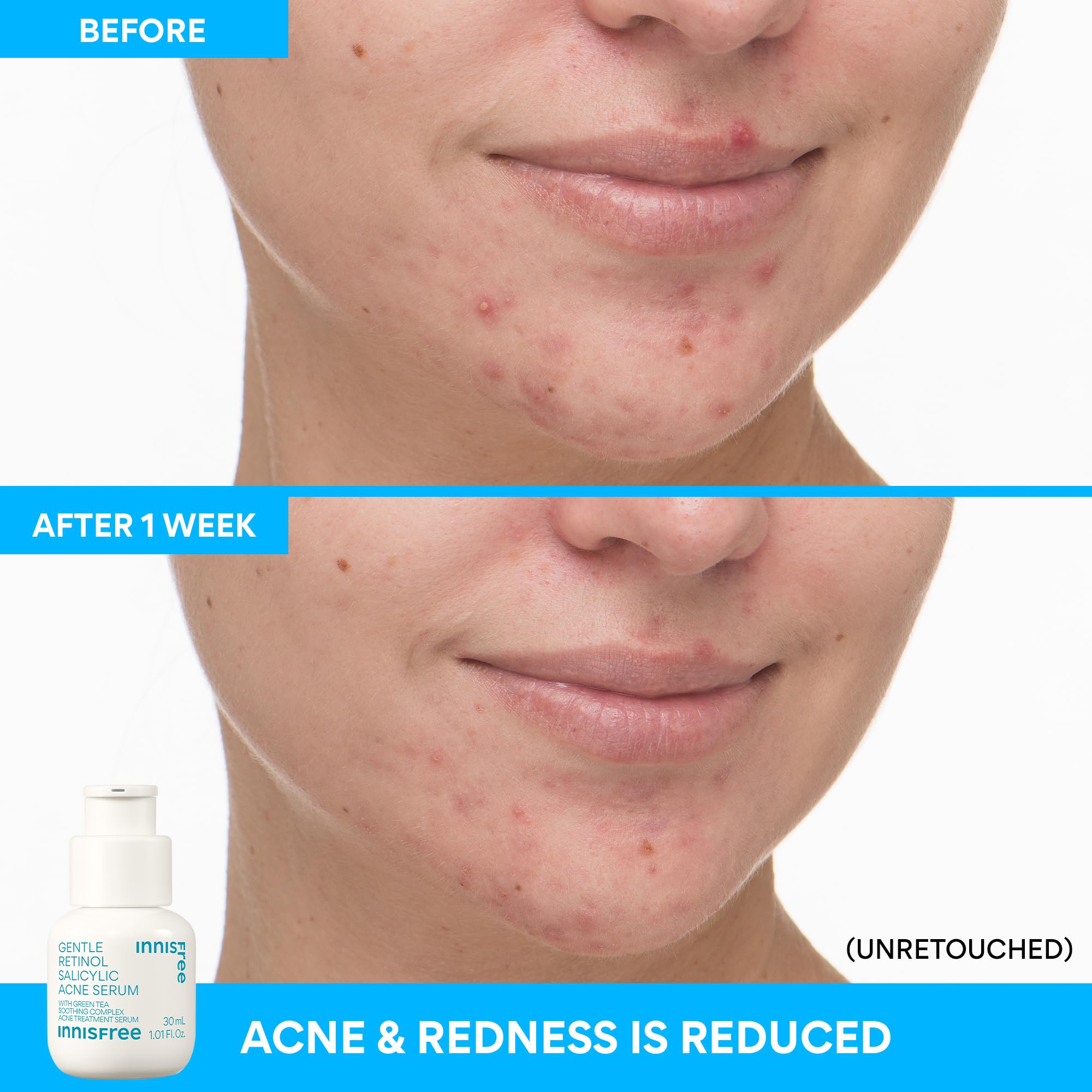 Innisfree serum on skin demonstrates gentle absorption and redness calming.