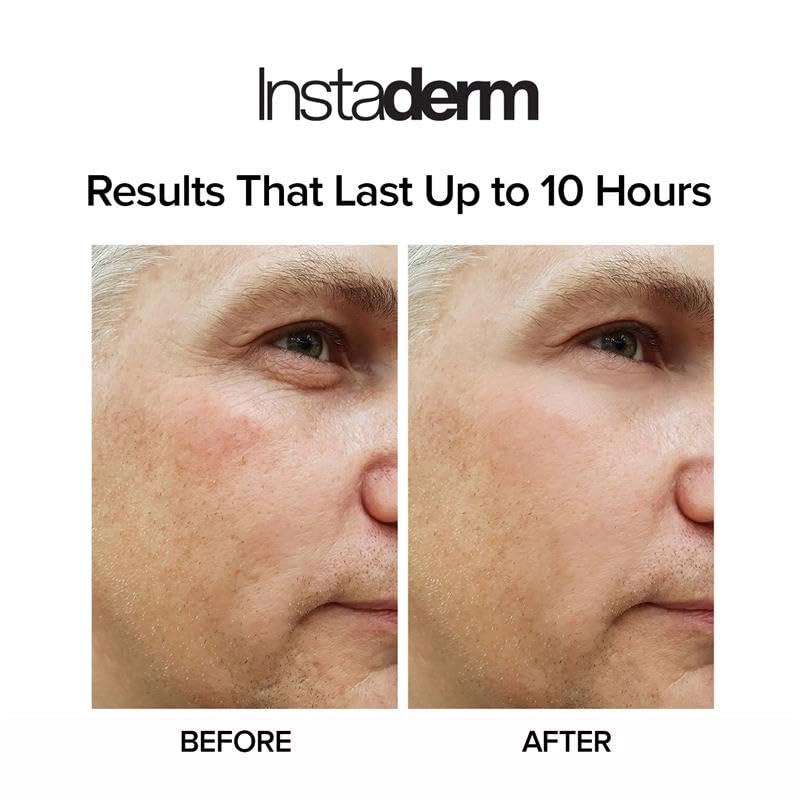Instaderm before-after eyes demonstrates refreshed appearance.