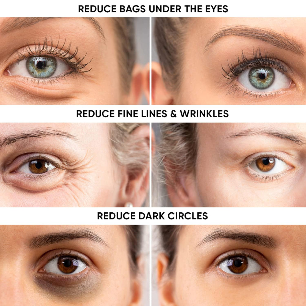 Instaderm under-eye close-up shows smoother skin around the eye area.