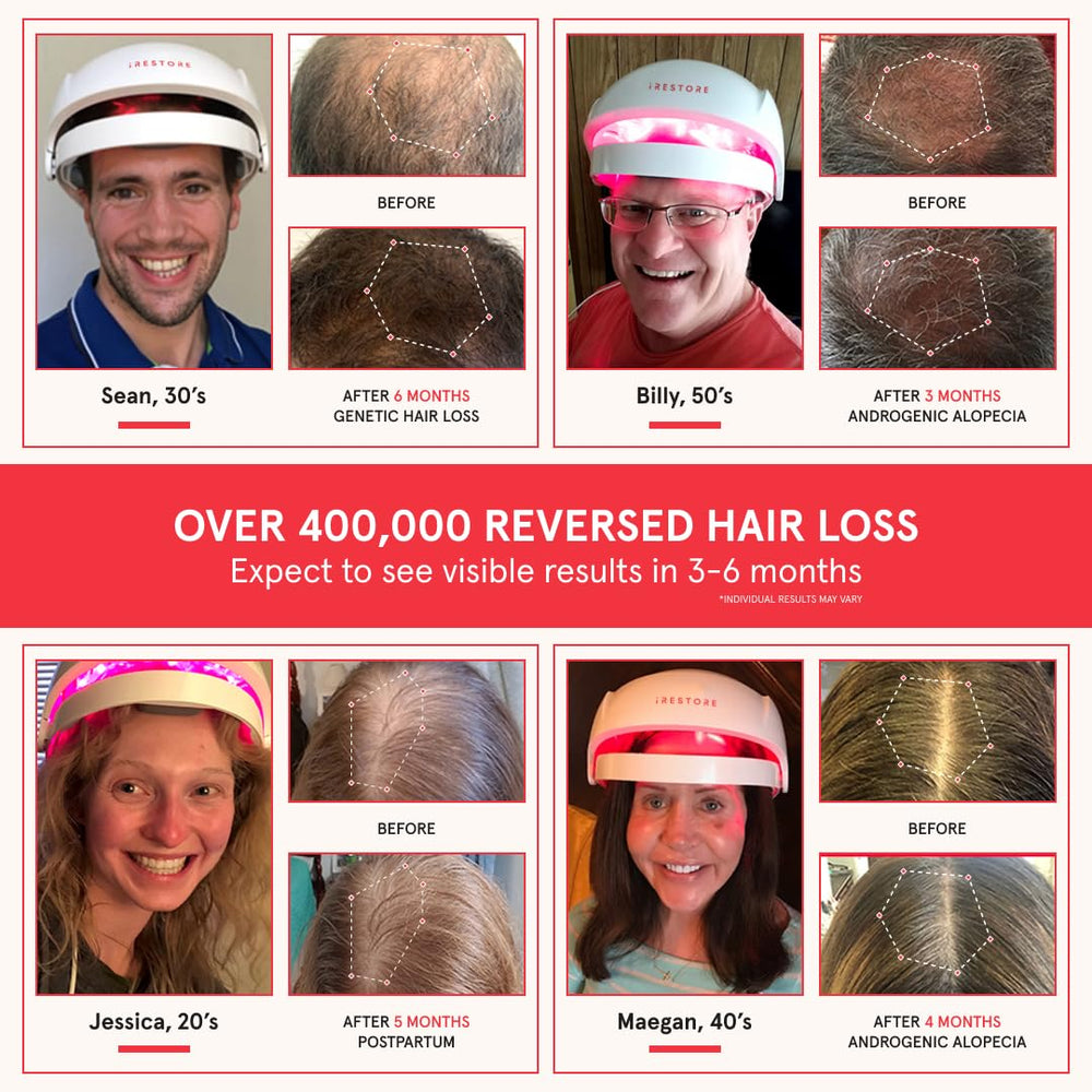iRestore Essential worn on head for discreet at-home hair regrowth routine.