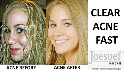 JOESOEF SKIN CARE azufre para espinillas y puntos negros, limpieza profunda.