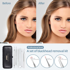 JPNK stainless steel pimple extractor showing durable, rust-resistant design