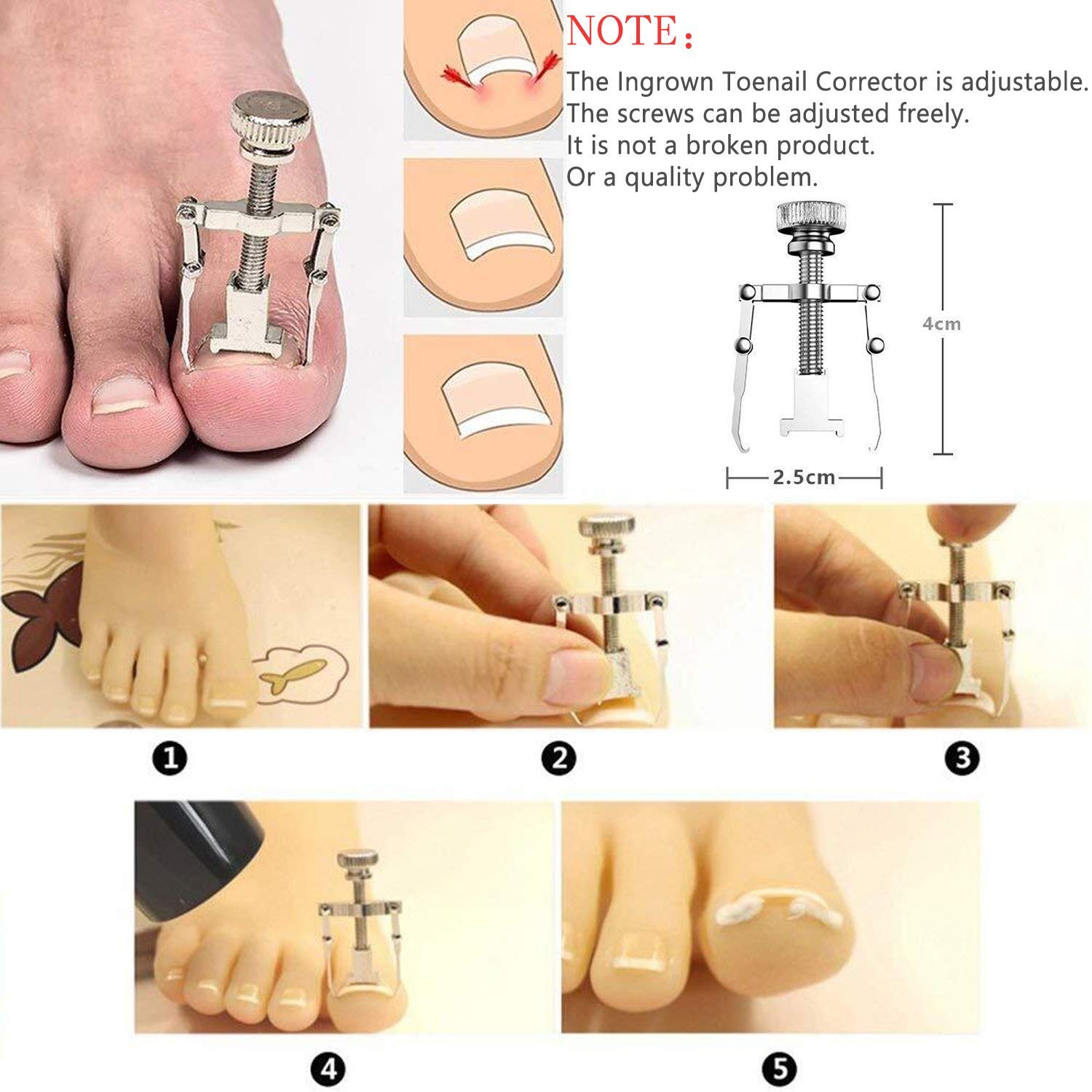 JTIEO ingrown toenail corrector lever mechanism demonstrated for gentle nail growth angle change