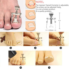 JTIEO ingrown toenail corrector lever mechanism demonstrated for gentle nail growth angle change