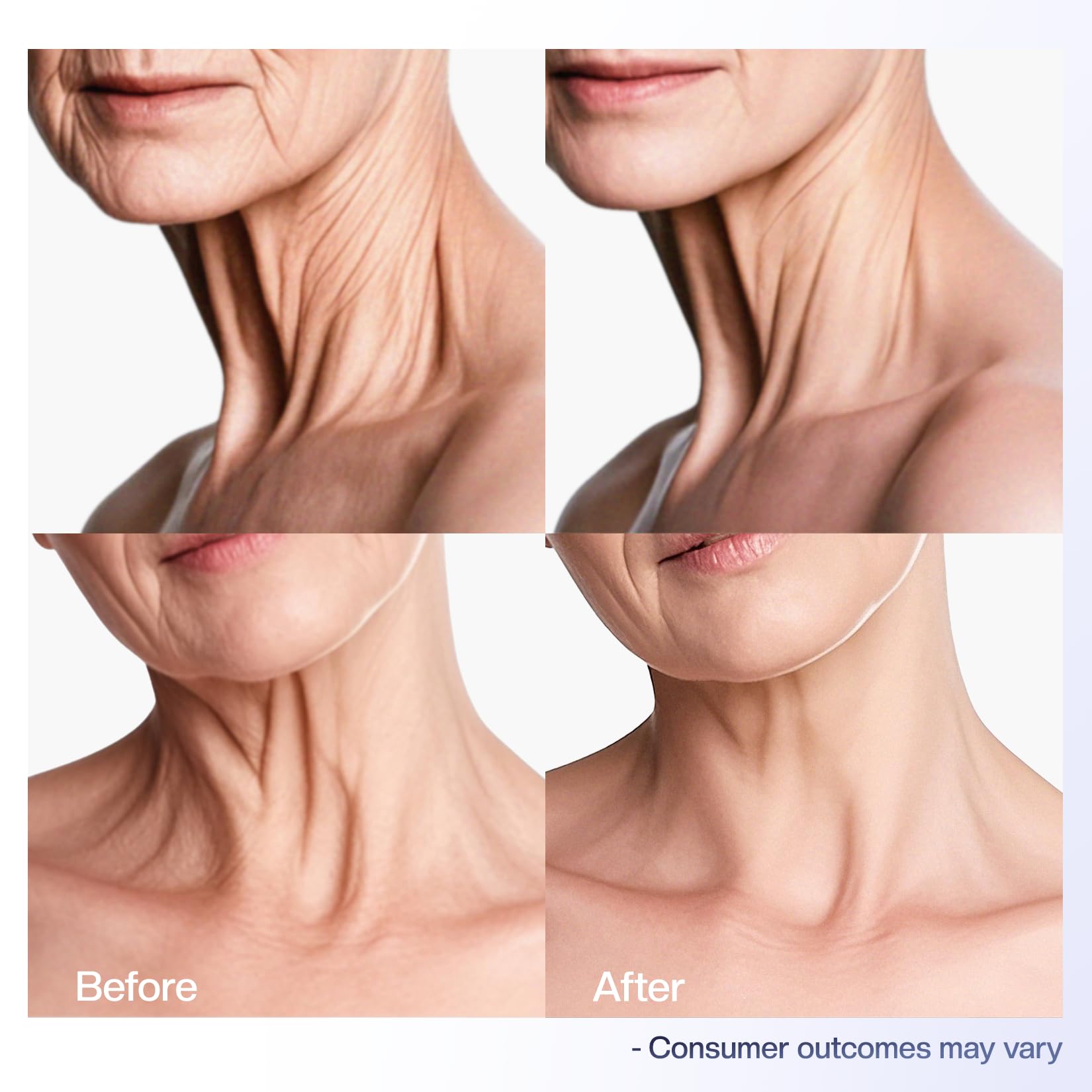 Ingredientes acacia y hialurónico en crema cuello Jtopyrt, nutrición efectiva.