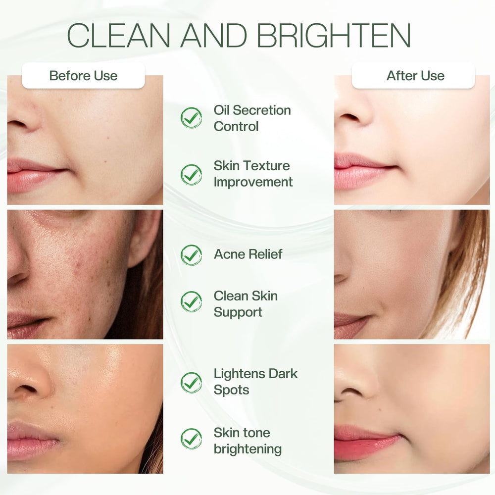 Jtopyrt 20% acid pads help shrink pores and reduce shine on oily skin.