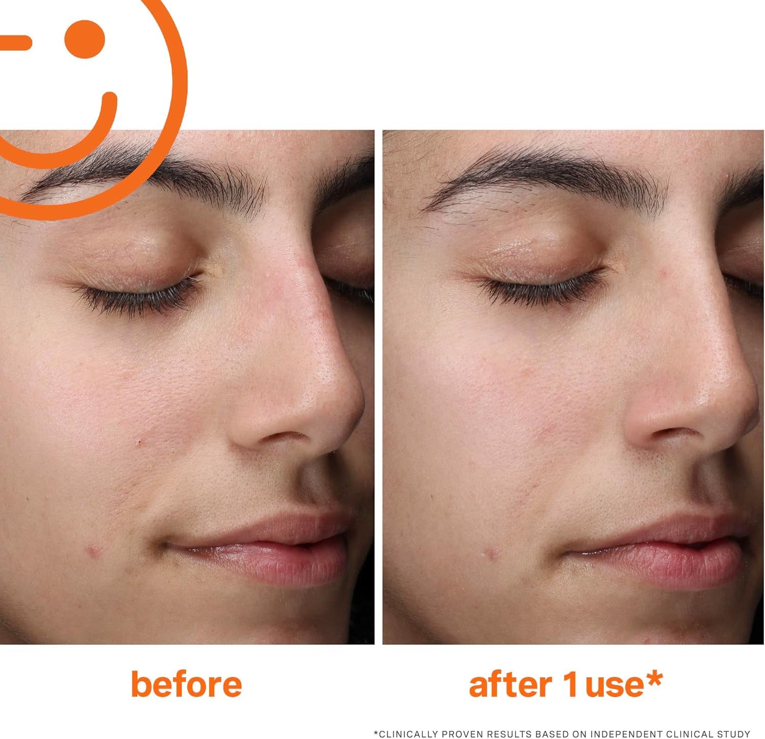 Glycolic and lactic acids in Exfolikate Cleanser for surface renewal
