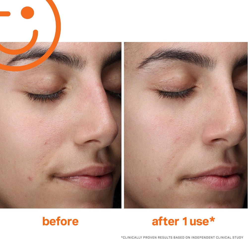Glycolic and lactic acids in Exfolikate Cleanser for surface renewal