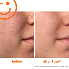 Kate Somerville Exfolikate ingredients reveal acids and enzymes for skin refinement