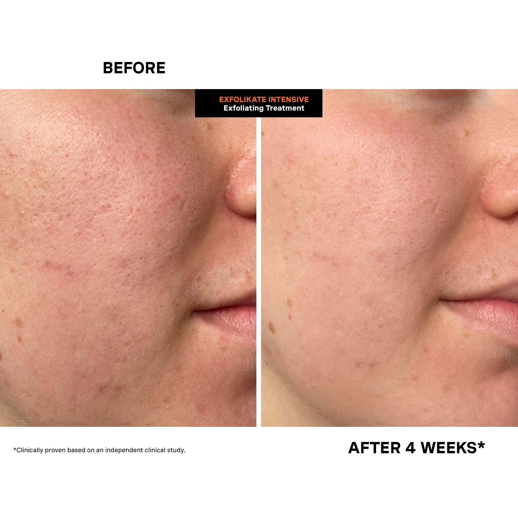 Kate Somerville Exfolikate Intensive claims 94% texture improvement.