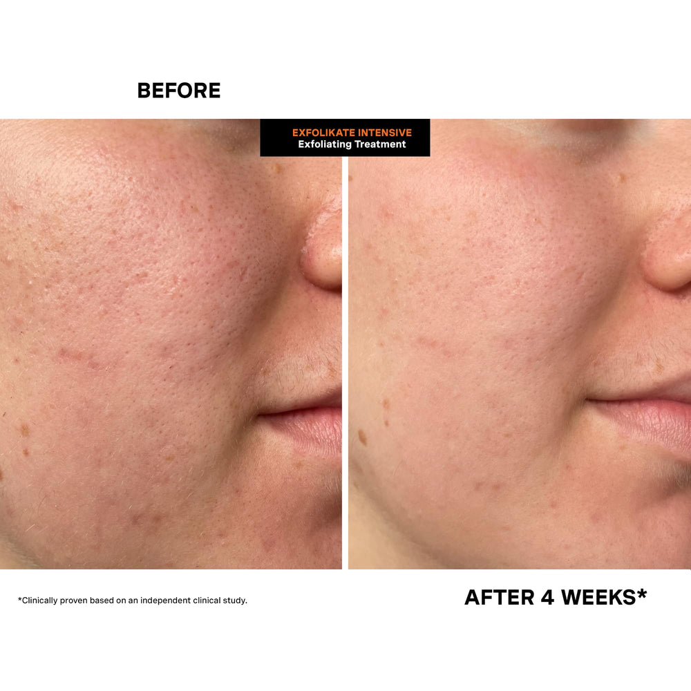 Kate Somerville Exfolikate Intensive claims 94% texture improvement.