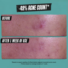 Kiehl's Acne-Treating Cleansing Paste with kaolin clay for oil absorption