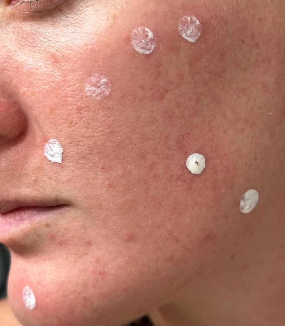 LANBENA loción secante para acné: seca granos suave durante la noche