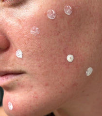 LANBENA loción secante para acné: seca granos suave durante la noche