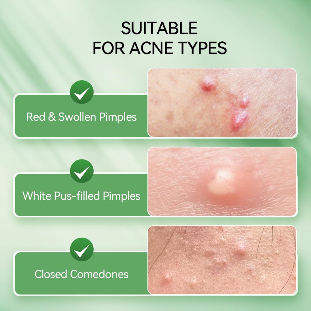 LANBENA serum spot acne punto en la piel, cuidado localizado.