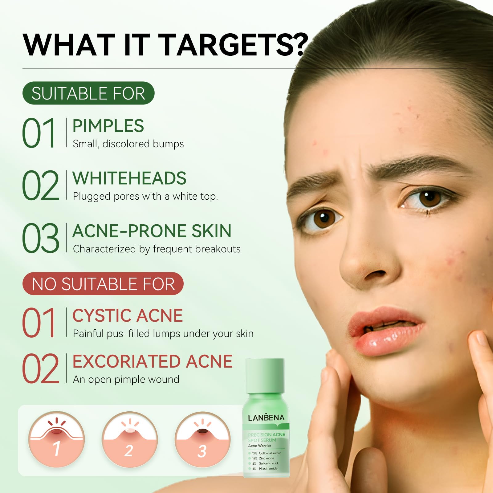 LANBENA tratamiento nocturno para acné: reduce tamaño de granos sin irritar