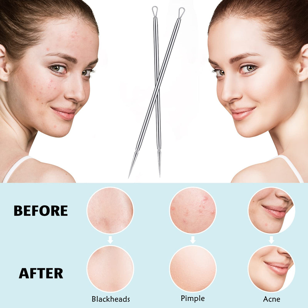 Lanties comedone extractor tool for targeted blemish removal.