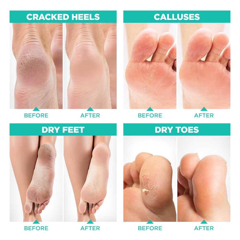 Lavinso foot mask peeling progress indicating improving skin texture.