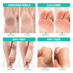 Lavinso foot mask peeling progress indicating improving skin texture.